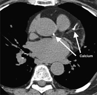 CT Calcium Score Los Angeles